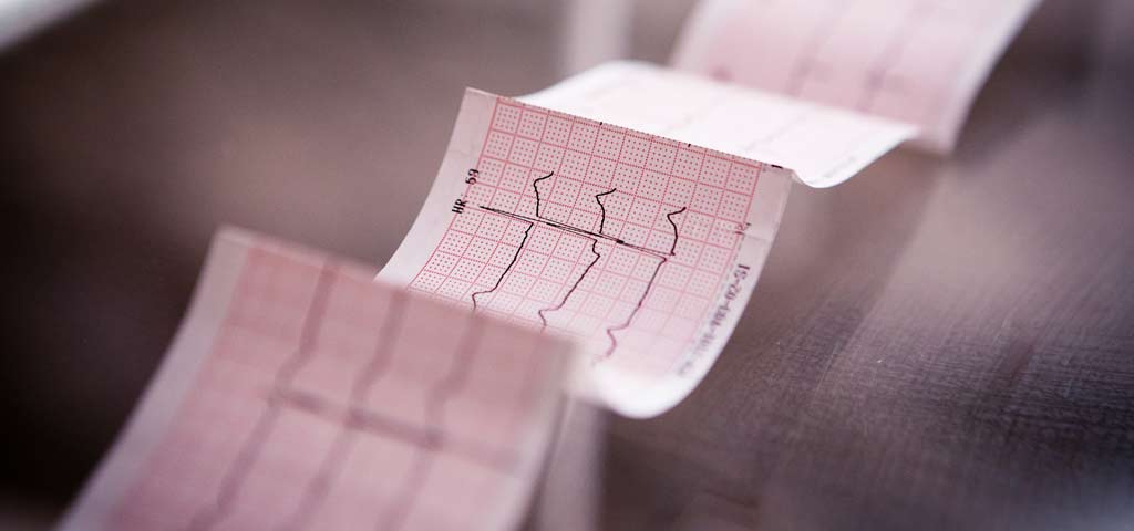 ausgedrucktes EKG mit dargestellter Herzfrequenz 