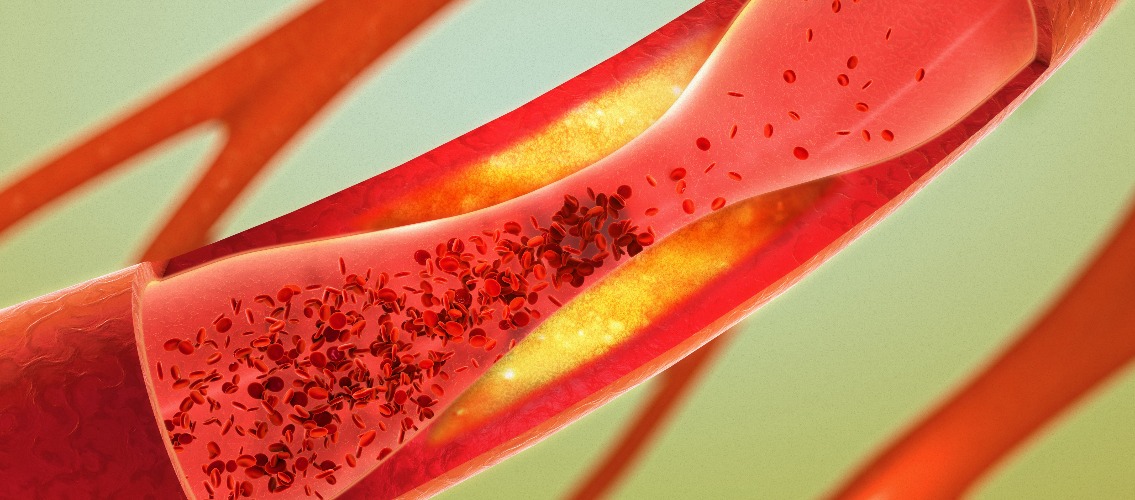 Ablagerung und verengung einer arterie arteriosklerose