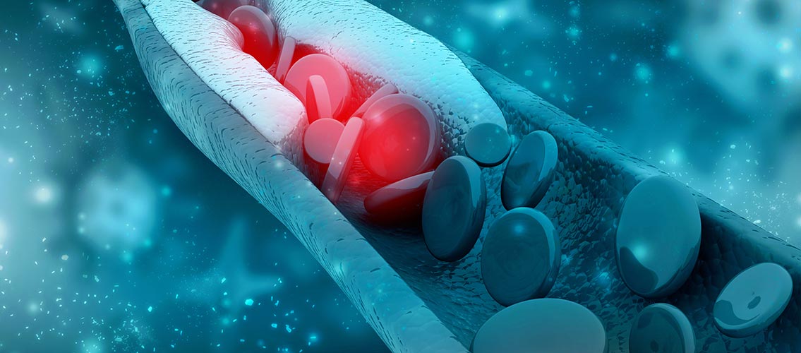 Cholesterin Plättchen in Blutbahnen