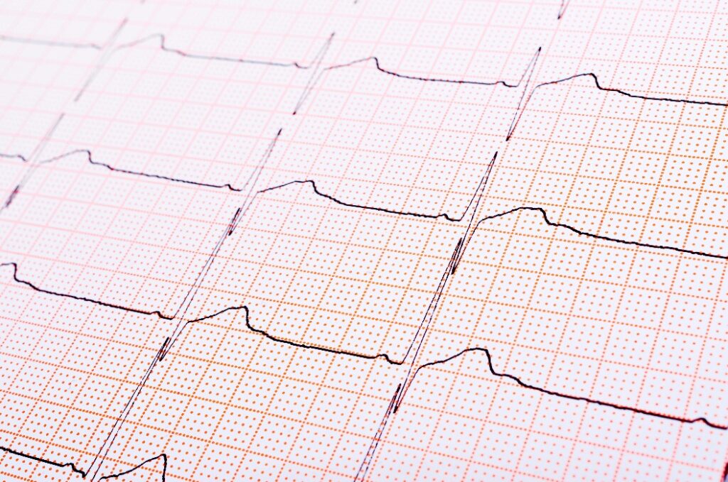 Event-Recorder Auswertung EKG